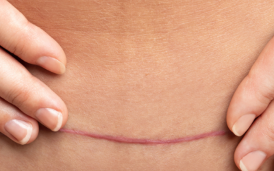 Improve your c-section scar mobility in just 5 minutes a day