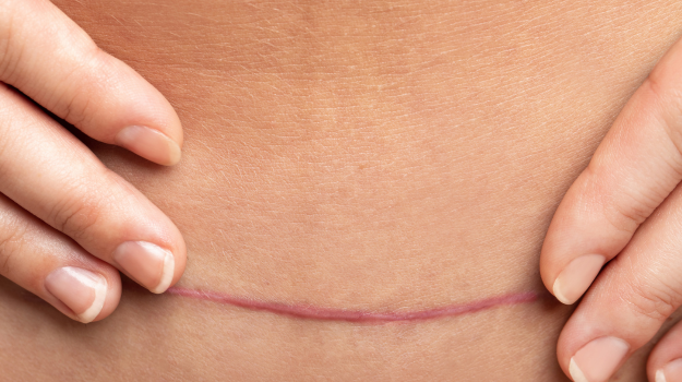 Improve your c-section scar mobility in just 5 minutes a day